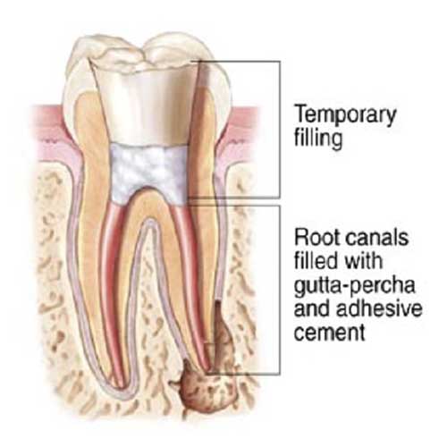 Root-Canal-2