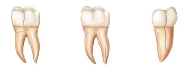 tooth-root-f