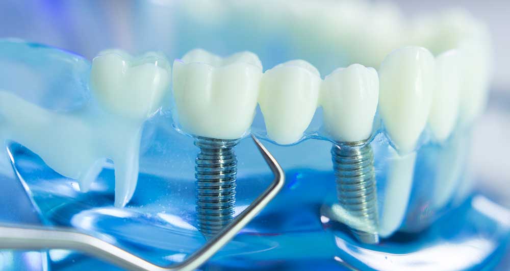 evaluation dental implants