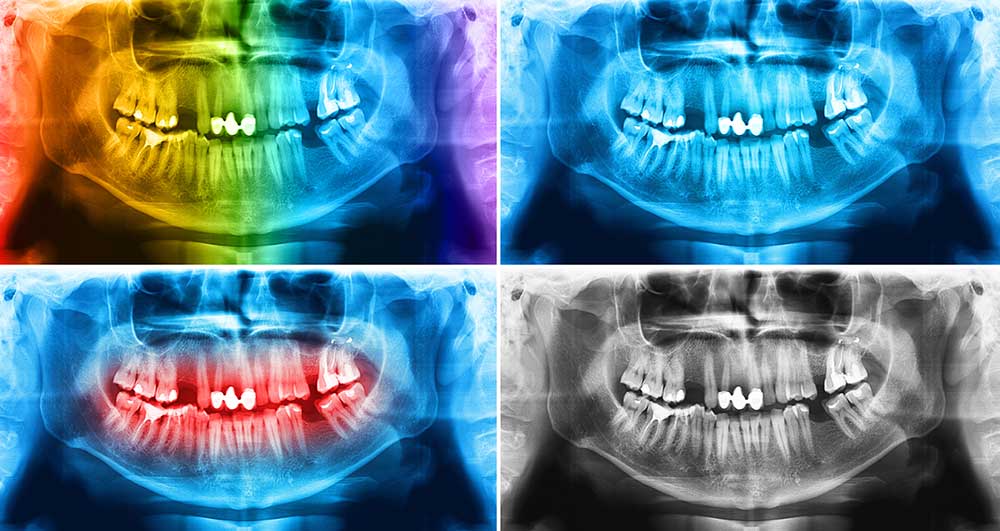 root canal retreatment